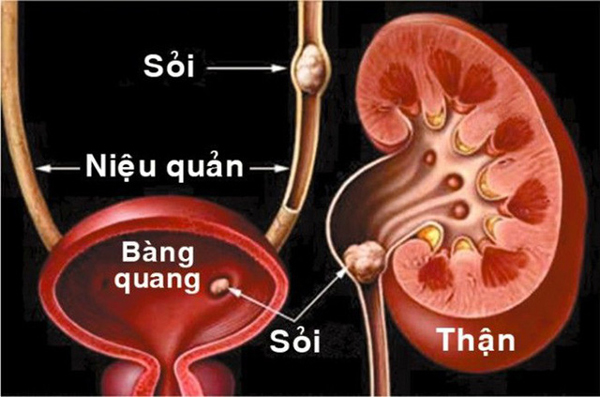 Một số phương pháp điều trị sỏi thận ngày nay